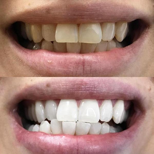 Blanqueamiento dental para unos dientes blancos. La imagen muestra un antes y un después de los dientes después del blanqueamiento.