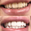 Dientes blancos y brillantes gracias al blanqueamiento dental Diamond