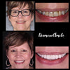 Blanqueamiento dental - Set de blanqueamiento dental de Diamond Smile
