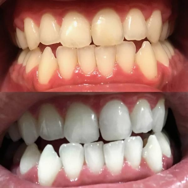 Dientes blancos después de blanquearlos con un kit de blanqueamiento dental y un gel blanqueador.