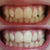 Dientes blancos y amarillos. Dientes blancos tras el blanqueamiento dental con gel blanqueador. Blanquear los dientes con el blanqueamiento dental.