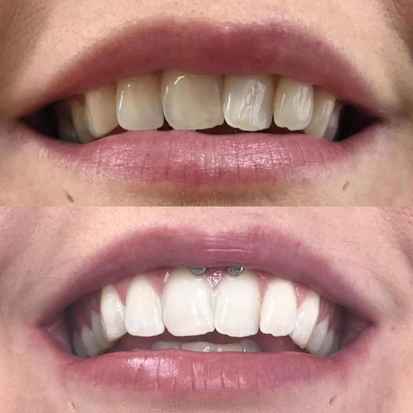 Dientes después del blanqueamiento dental.