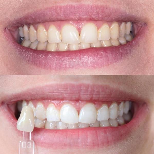 Dientes blancos gracias al blanqueo dental. Fotos de una mujer después de un blanqueamiento dental.