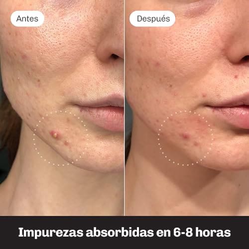 Parches Anti-Acné