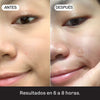 Parches Anti-Acné