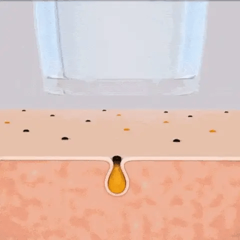 Set Eliminador de Puntos Negros